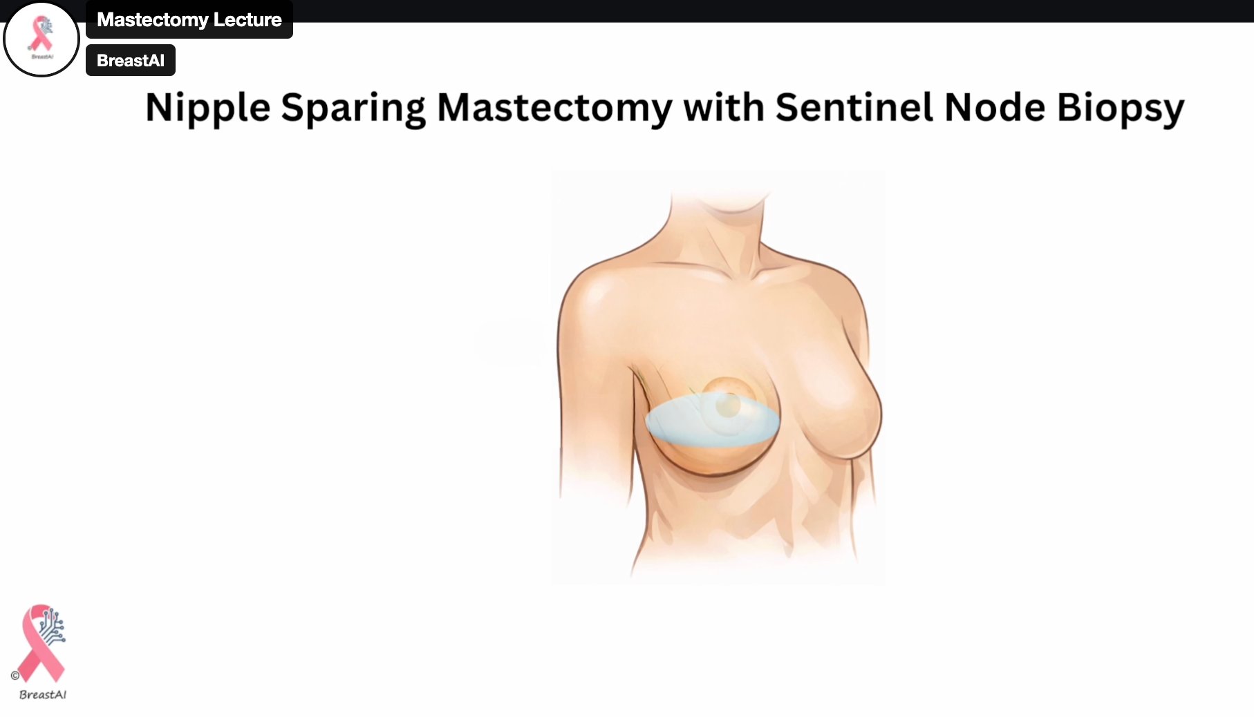Mastectomy Lecture
